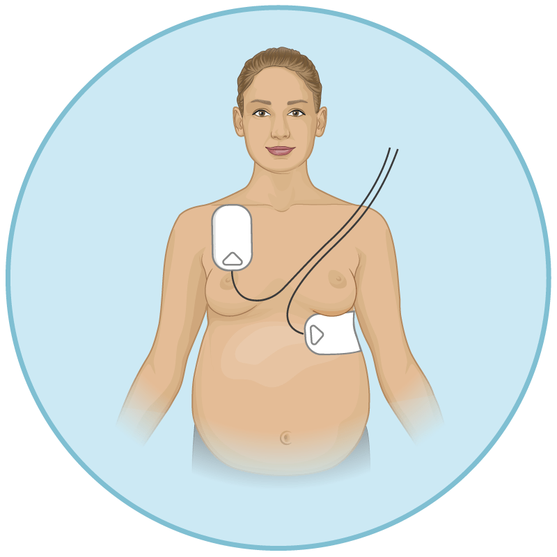 AED for pregnant woman - defibrillator pad positioning