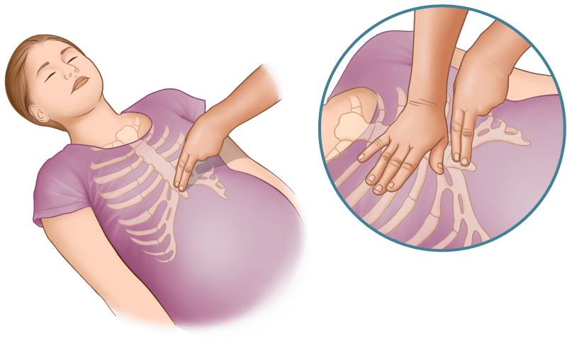 Pregnancy CPR - chest compressions, hand positioning